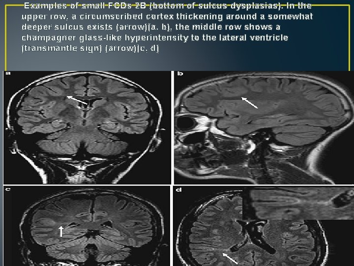 Examples of small FCDs 2 B (bottom of sulcus dysplasias). In the upper row, Examples of small FCDs 2 B (bottom of sulcus dysplasias). In the upper row,