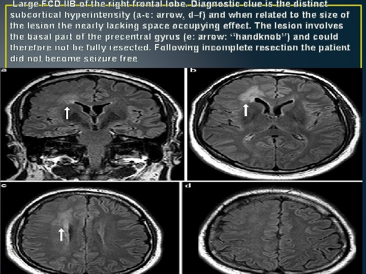 Large FCD IIB of the right frontal lobe. Diagnostic clue is the distinct subcortical Large FCD IIB of the right frontal lobe. Diagnostic clue is the distinct subcortical