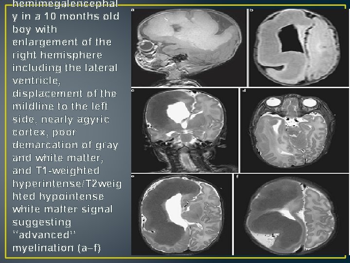 hemimegalencephal y in a 10 months old boy with enlargement of the right hemisphere hemimegalencephal y in a 10 months old boy with enlargement of the right hemisphere