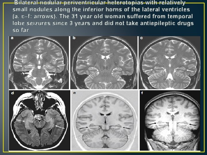 Bilateral nodular periventricular heterotopias with relatively small nodules along the inferior horns of the Bilateral nodular periventricular heterotopias with relatively small nodules along the inferior horns of the
