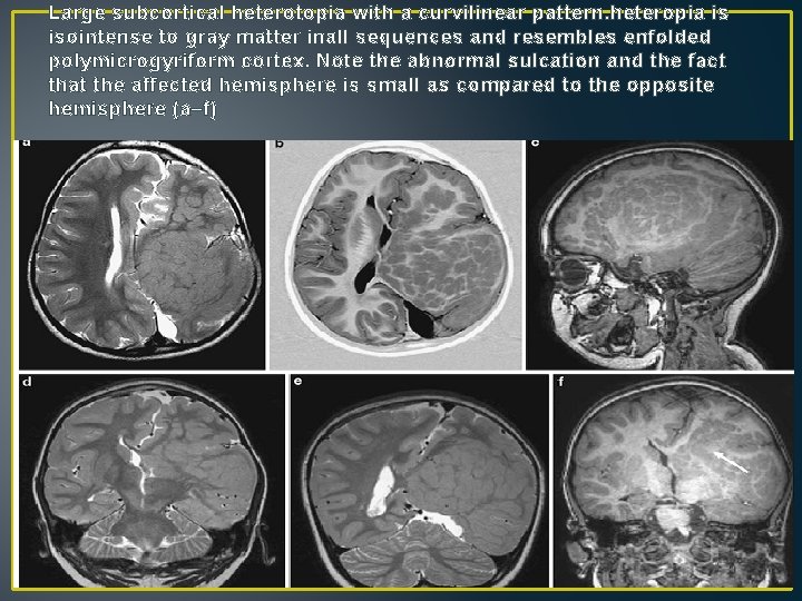 Large subcortical heterotopia with a curvilinear pattern. heteropia is isointense to gray matter inall Large subcortical heterotopia with a curvilinear pattern. heteropia is isointense to gray matter inall