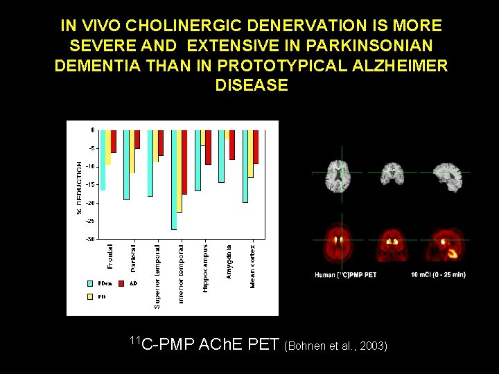 IN VIVO CHOLINERGIC DENERVATION IS MORE SEVERE AND EXTENSIVE IN PARKINSONIAN DEMENTIA THAN IN