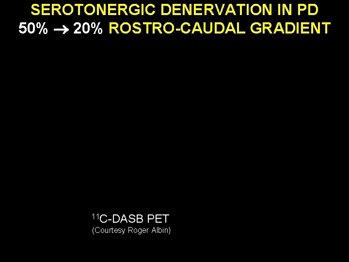 SEROTONERGIC DENERVATION IN PD 50% 20% ROSTRO-CAUDAL GRADIENT 11 C-DASB PET (Courtesy Roger Albin)