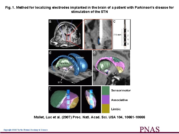 Fig. 1. Method for localizing electrodes implanted in the brain of a patient with