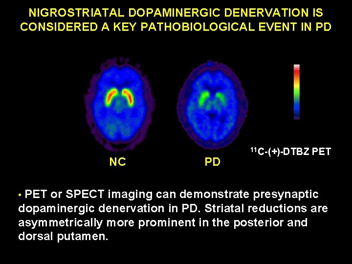 NIGROSTRIATAL DOPAMINERGIC DENERVATION IS CONSIDERED A KEY PATHOBIOLOGICAL EVENT IN PD NC PD 11