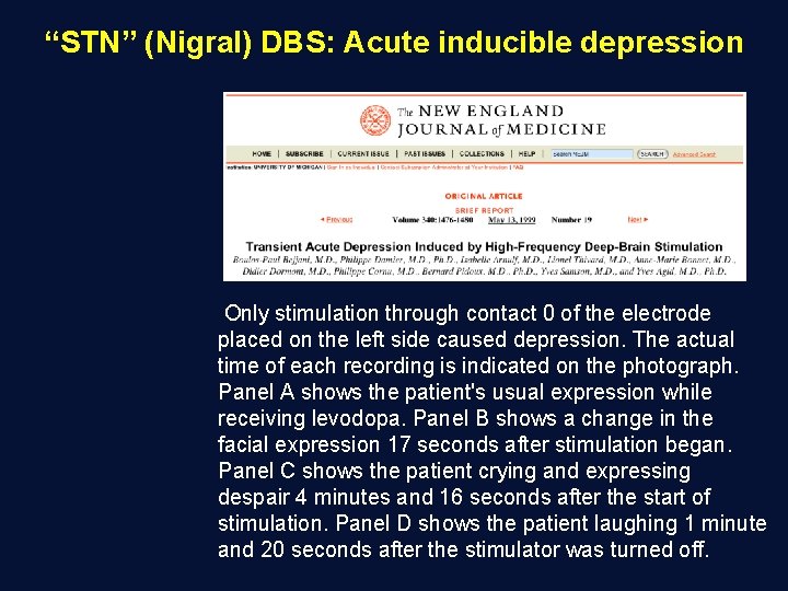 “STN” (Nigral) DBS: Acute inducible depression Only stimulation through contact 0 of the electrode