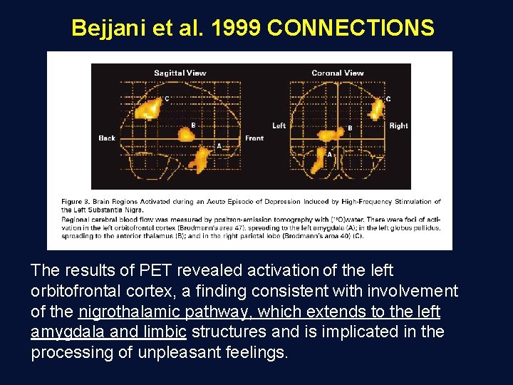 Bejjani et al. 1999 CONNECTIONS The results of PET revealed activation of the left