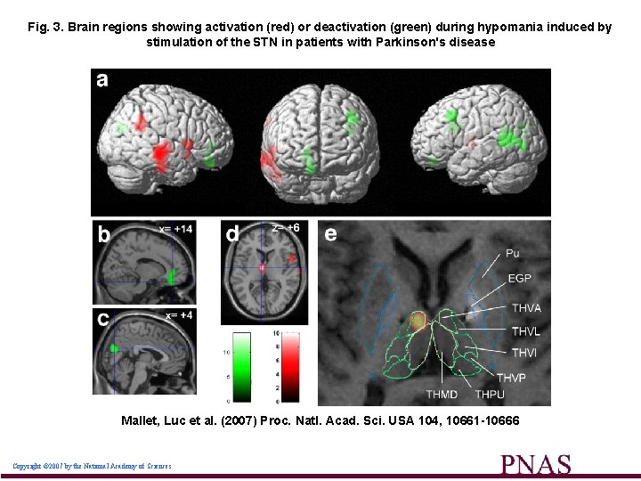 Fig. 3. Brain regions showing activation (red) or deactivation (green) during hypomania induced by