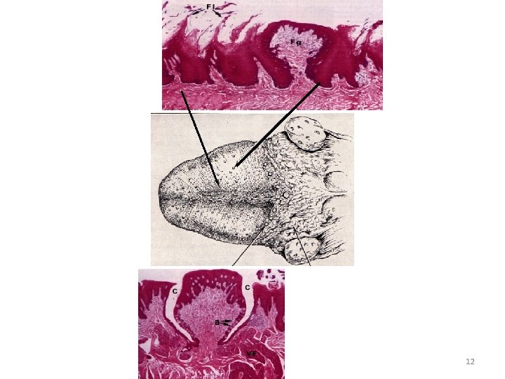 TONSILLA LINGUALIS 12 