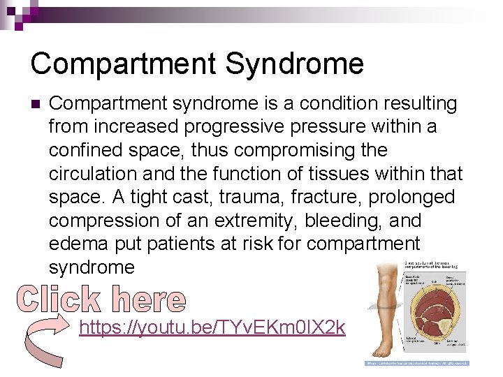 Compartment Syndrome n Compartment syndrome is a condition resulting from increased progressive pressure within