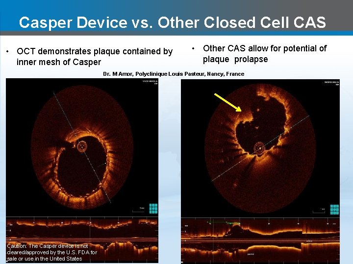 Casper Device vs. Other Closed Cell CAS • OCT demonstrates plaque contained by inner