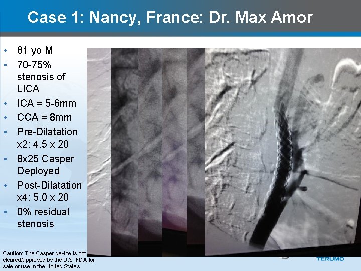 Case 1: Nancy, France: Dr. Max Amor • 81 yo M • 70 -75%
