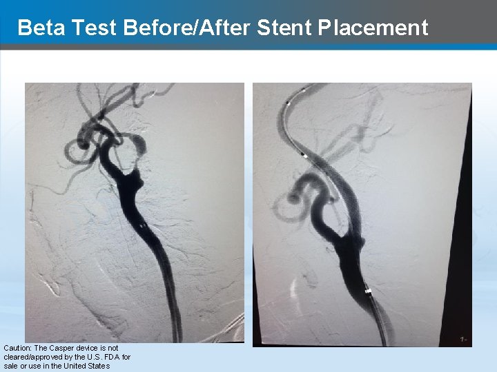 Beta Test Before/After Stent Placement Caution: The Casper device is not cleared/approved by the
