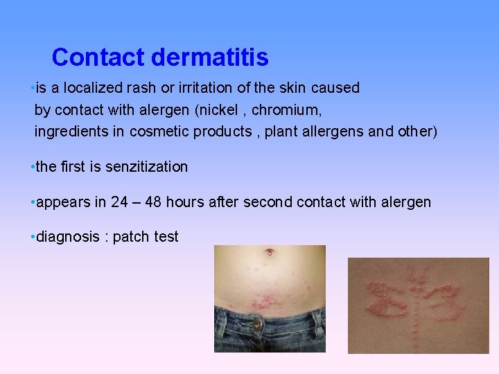 Contact dermatitis • is a localized rash or irritation of the skin caused by