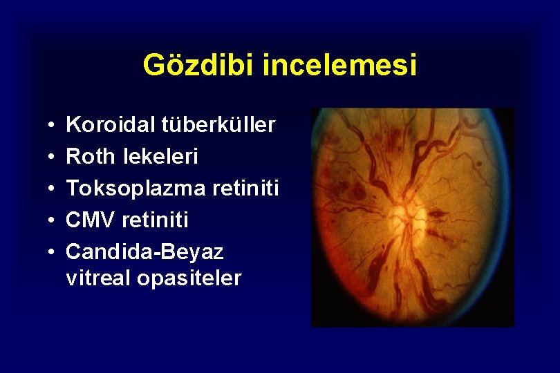 Gözdibi incelemesi • • • Koroidal tüberküller Roth lekeleri Toksoplazma retiniti CMV retiniti Candida-Beyaz