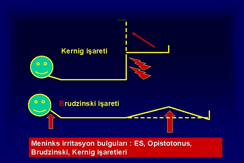 Kernig işareti Brudzinski işareti Meninks irritasyon bulguları : ES, Opistotonus, Brudzinski, Kernig işaretleri 