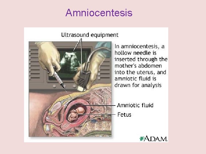 Amniocentesis 