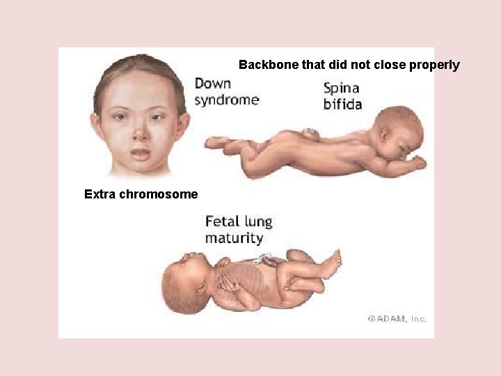 Backbone that did not close properly Extra chromosome 