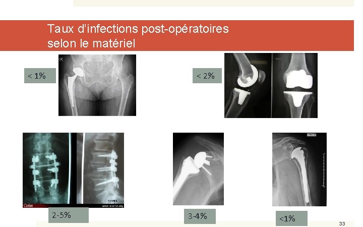 Taux d’infections post-opératoires selon le matériel < 1% < 2% 2 -5% 3 -4%