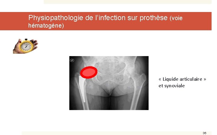 Physiopathologie de l’infection sur prothèse (voie hématogène) « Liquide articulaire » et synoviale 36