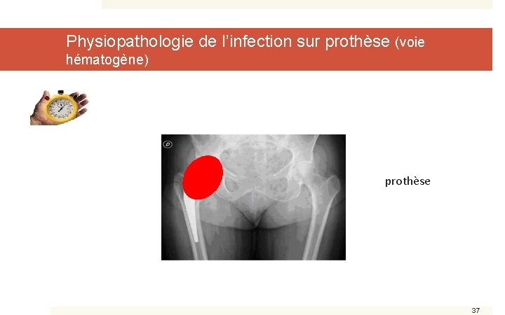 Physiopathologie de l’infection sur prothèse (voie hématogène) prothèse 37 