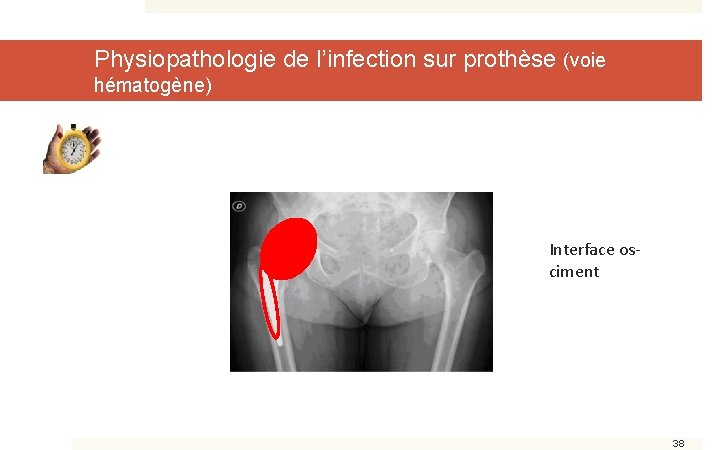 Physiopathologie de l’infection sur prothèse (voie hématogène) Interface osciment 38 