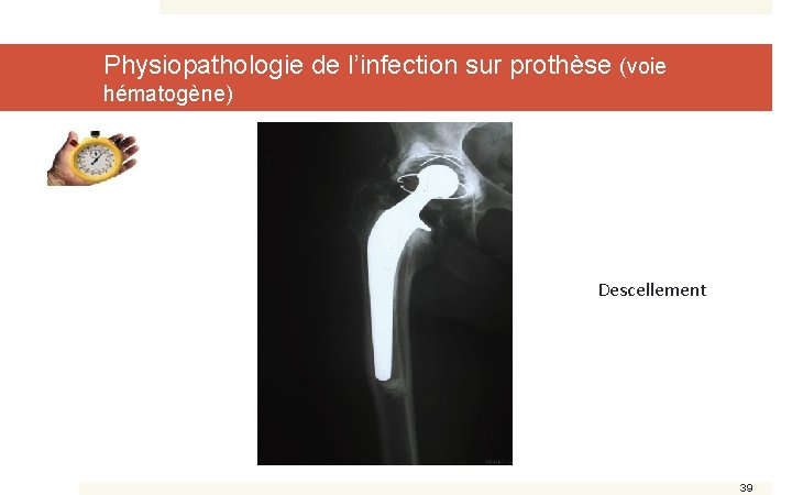 Physiopathologie de l’infection sur prothèse (voie hématogène) Descellement 39 