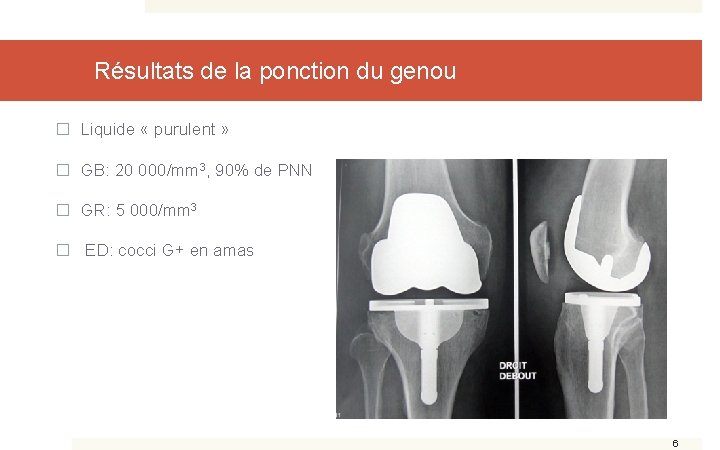 Résultats de la ponction du genou � Liquide « purulent » � GB: 20