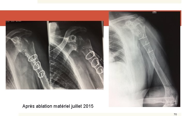 Après ablation matériel juillet 2015 70 