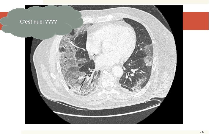 C’est quoi ? ? TDM Thorax 74 