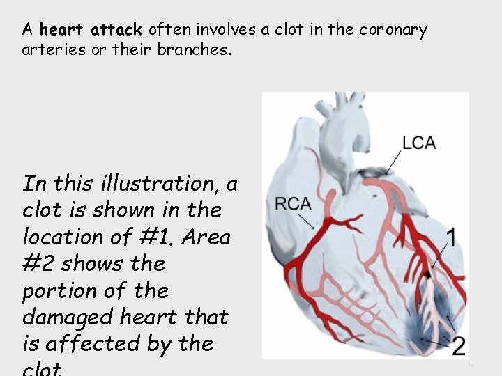 A heart attack often involves a clot in the coronary arteries or their branches.