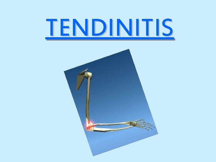 TENDINITIS 