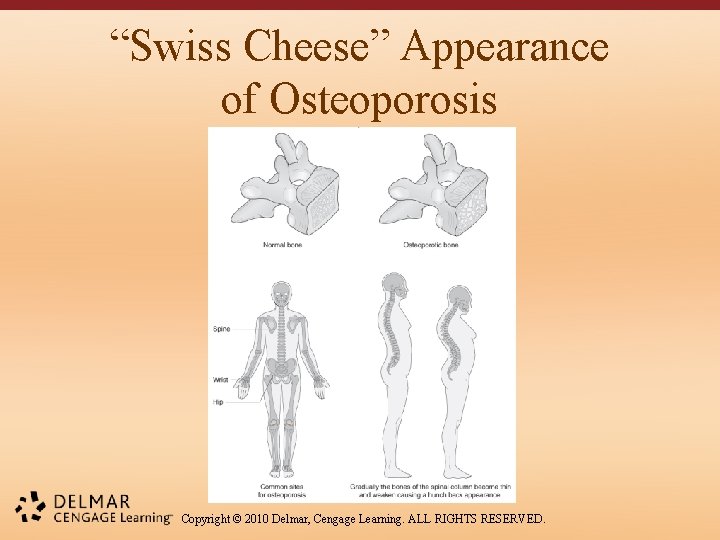 “Swiss Cheese” Appearance of Osteoporosis Copyright © 2010 Delmar, Cengage Learning. ALL RIGHTS RESERVED.