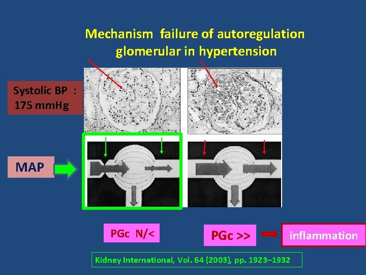Mechanism failure of autoregulation glomerular in hypertension Systolic BP : 175 mm. Hg MAP