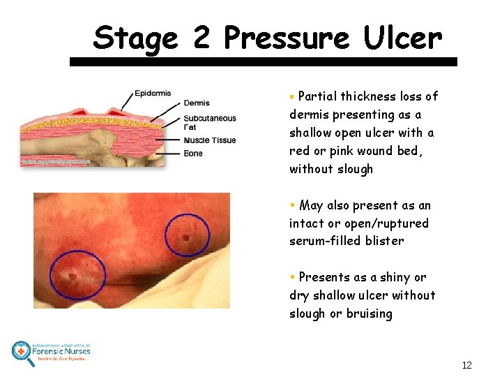 Stage 2 Pressure Ulcer § Partial thickness loss of dermis presenting as a shallow