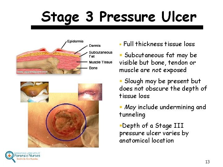 Stage 3 Pressure Ulcer § Full thickness tissue loss § Subcutaneous fat may be