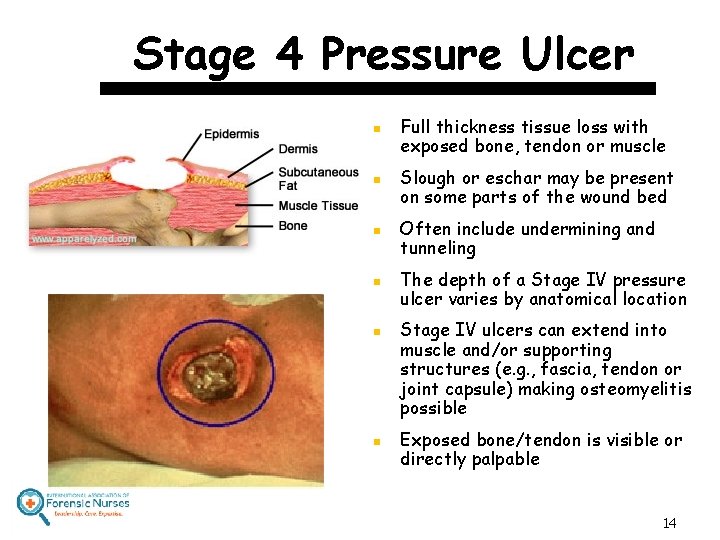 Stage 4 Pressure Ulcer n n n Full thickness tissue loss with exposed bone,