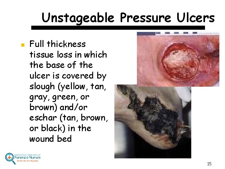 Unstageable Pressure Ulcers n Full thickness tissue loss in which the base of the