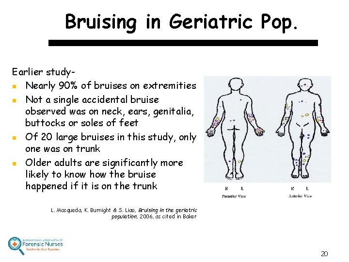 Bruising in Geriatric Pop. Earlier studyn Nearly 90% of bruises on extremities n Not