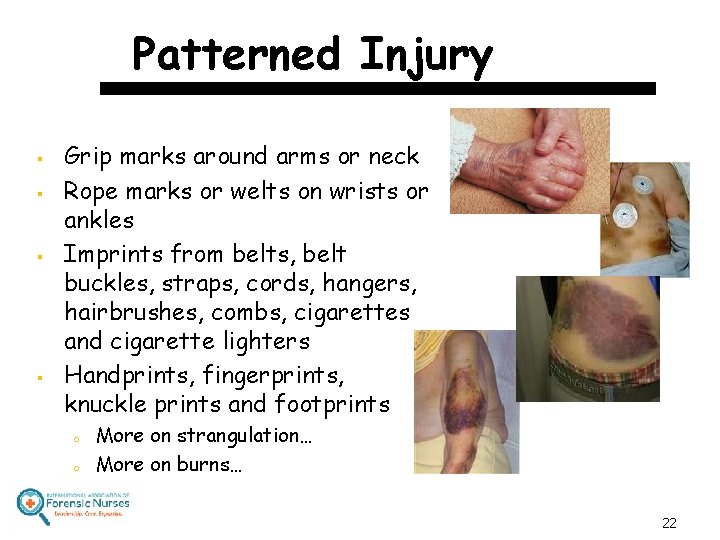 Patterned Injury § § Grip marks around arms or neck Rope marks or welts