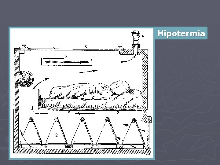 Hipotermia 