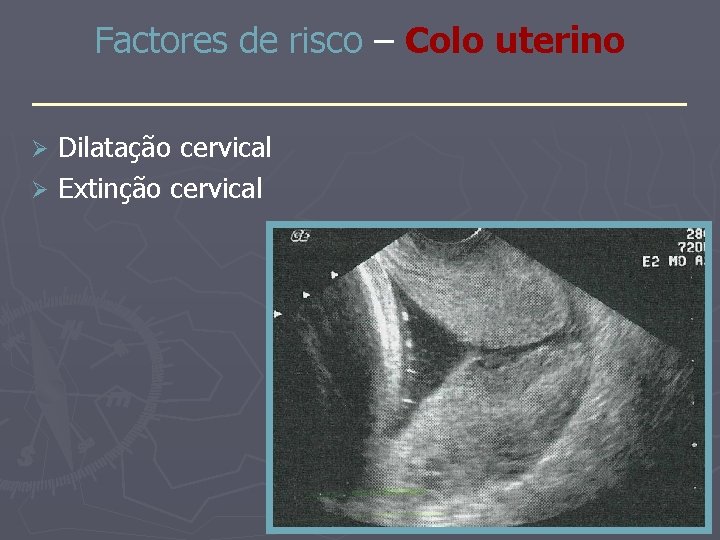 Factores de risco – Colo uterino _______________ Dilatação cervical Ø Extinção cervical Ø 