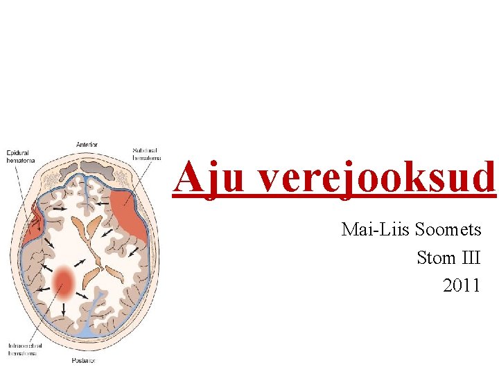 Aju verejooksud Mai-Liis Soomets Stom III 2011 