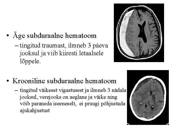 • Äge subduraalne hematoom – tingitud traumast, ilmneb 3 päeva jooksul ja viib