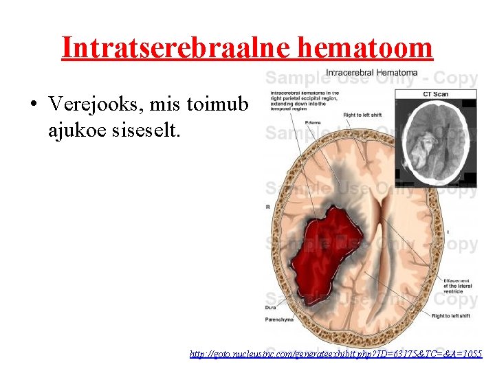 Intratserebraalne hematoom • Verejooks, mis toimub ajukoe siseselt. http: //goto. nucleusinc. com/generateexhibit. php? ID=63175&TC=&A=1055