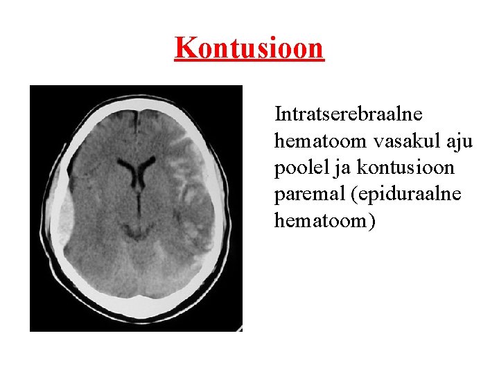Kontusioon Intratserebraalne hematoom vasakul aju poolel ja kontusioon paremal (epiduraalne hematoom) 