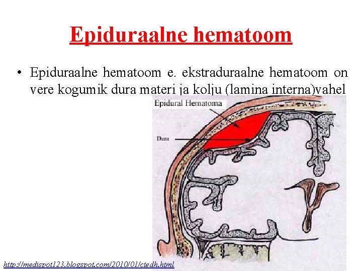 Epiduraalne hematoom • Epiduraalne hematoom e. ekstraduraalne hematoom on vere kogumik dura materi ja