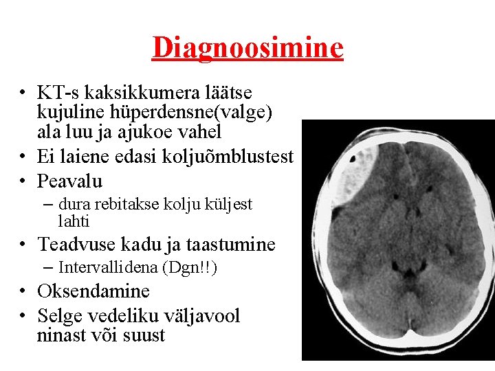 Diagnoosimine • KT-s kaksikkumera läätse kujuline hüperdensne(valge) ala luu ja ajukoe vahel • Ei
