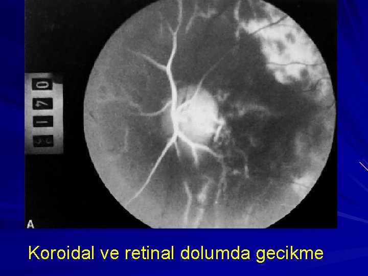 Koroidal ve retinal dolumda gecikme 