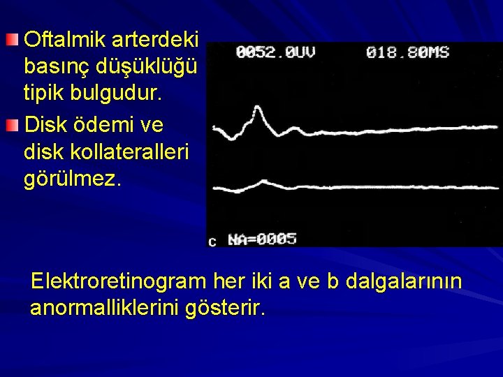 Oftalmik arterdeki basınç düşüklüğü tipik bulgudur. Disk ödemi ve disk kollateralleri görülmez. Elektroretinogram her